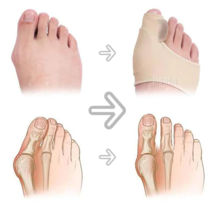 OrtoAlign® corrector